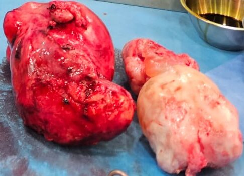 Challenging Surgery Saves 52-Years Woman from a Large Tumor​